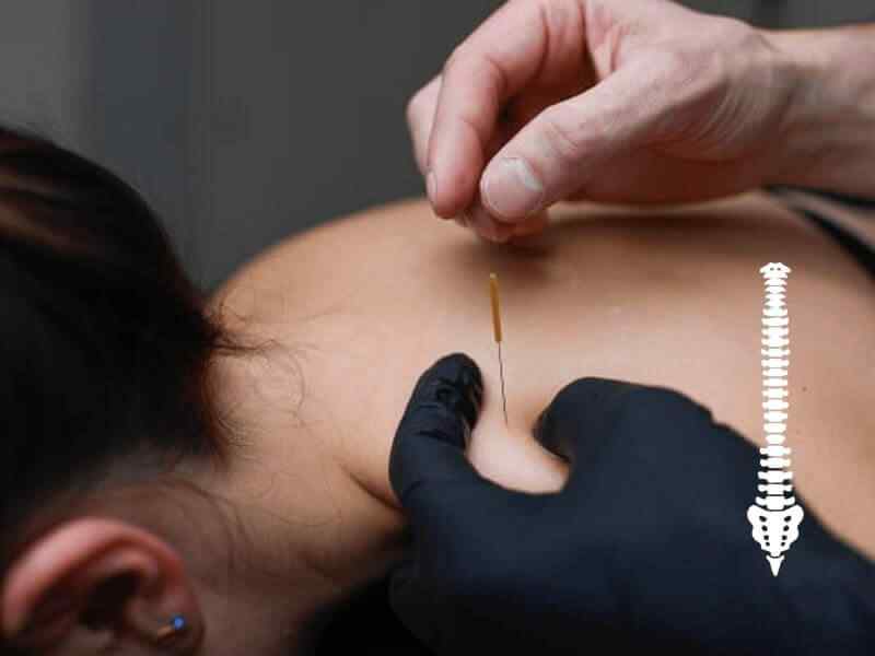 Dry Needling